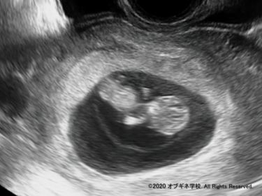 とてもわかりやすい胎児計測のはなし(Part1)│見えてくる産婦人科学