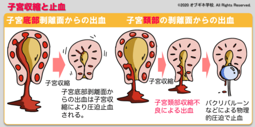 分娩編3 分娩第3期 新しい切り口の産婦人科学講座 │見えてくる産婦人科学 オブギネ学校