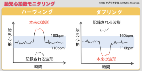 胎児心拍数モニタリング編2 新しい切り口の産婦人科学講座│見えてくる産婦人科学 オブギネ学校