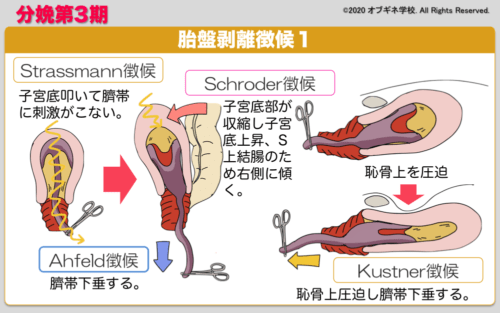 のの　中　剥離 ZX プロテクター | ケンコー・トキナー