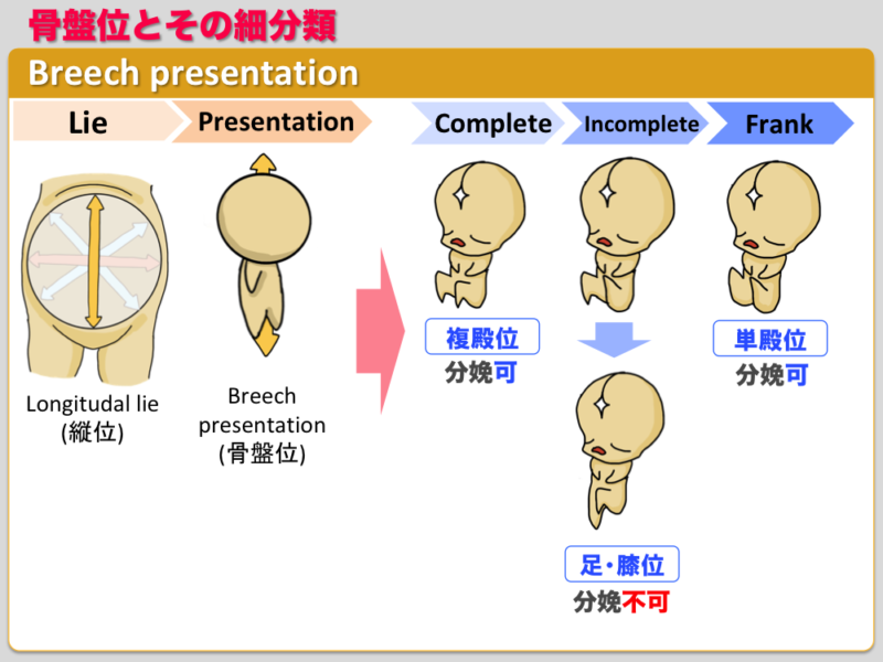 ALSO受験者必見！Lie, Presentation, Attitude, Position 欧米式の胎位・胎向・胎勢について│見えてくる産 ...