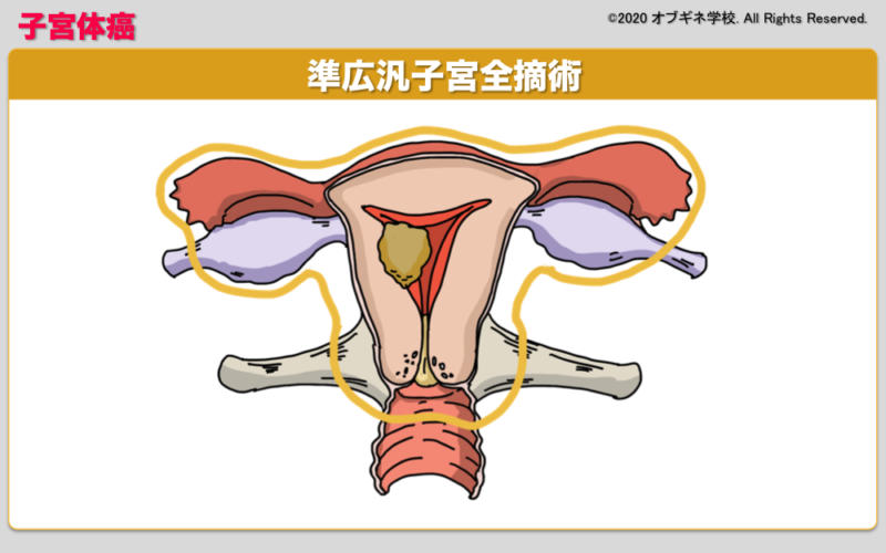 医学生のための婦人科癌手術の基本│見えてくる産婦人科学