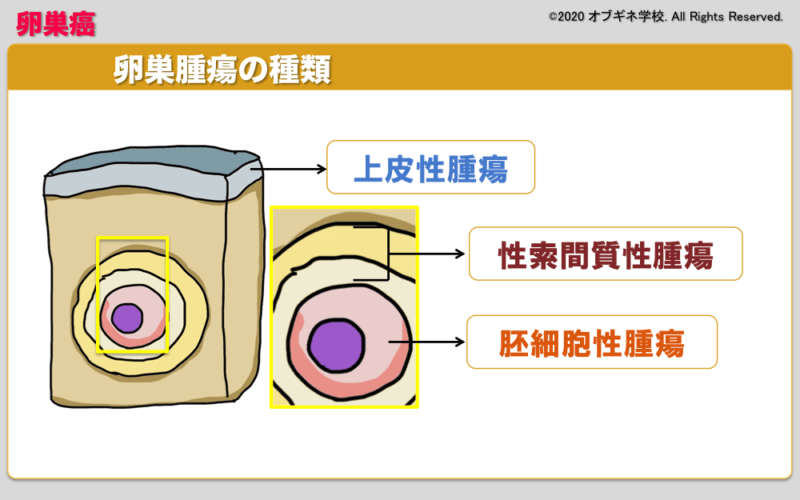 これなら分かる 卵巣腫瘍の種類の覚え方 見えてくる産婦人科学 オブギネ学校