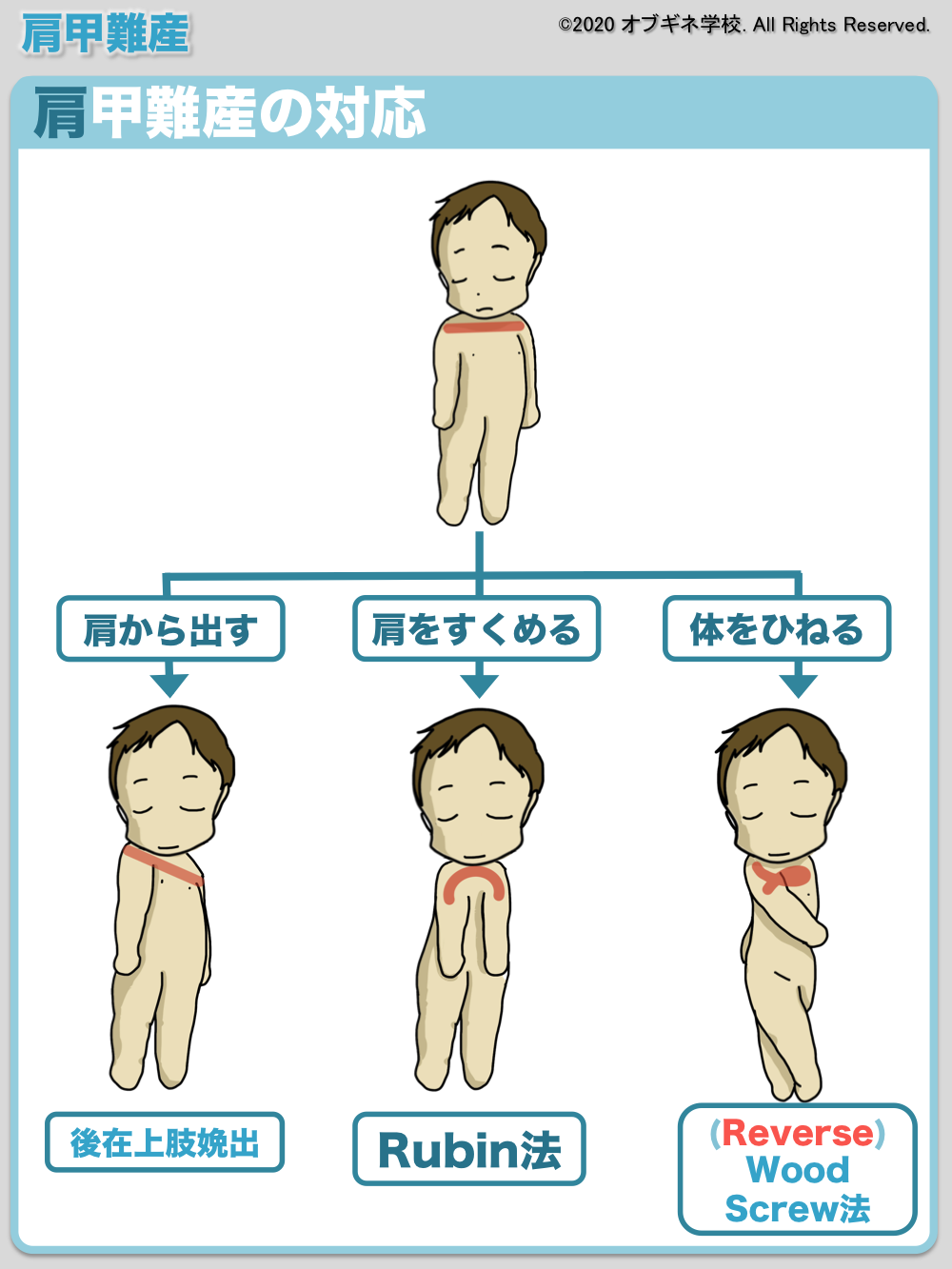 イラストから理解する肩甲難産の対処法 見えてくる産婦人科学 オブギネ学校