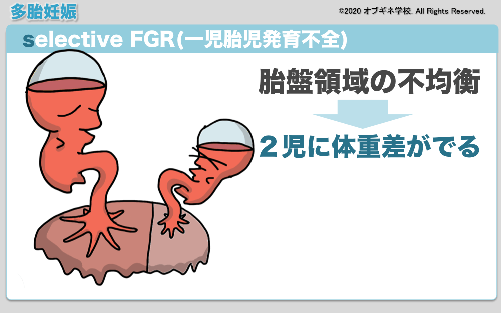 イラストから理解するMD双胎とその合併症│見えてくる産婦人科学 オブギネ学校