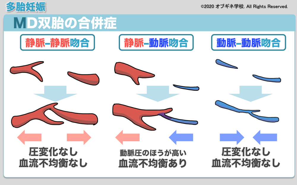 イラストから理解するMD双胎とその合併症│見えてくる産婦人科学 オブギネ学校