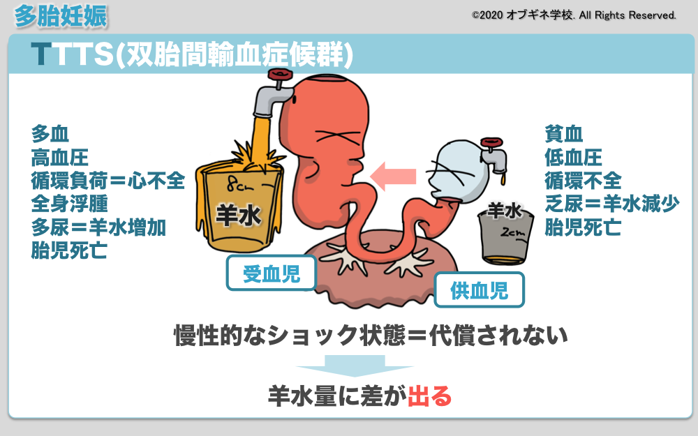 イラストから理解するMD双胎とその合併症│見えてくる産婦人科学 オブギネ学校