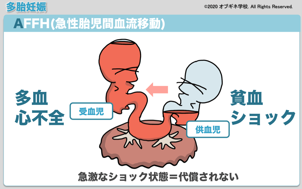 イラストから理解するMD双胎とその合併症│見えてくる産婦人科学 オブギネ学校