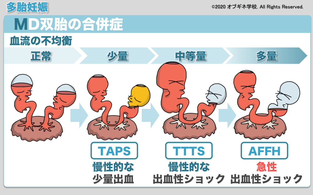 イラストから理解するMD双胎とその合併症│見えてくる産婦人科学 オブギネ学校
